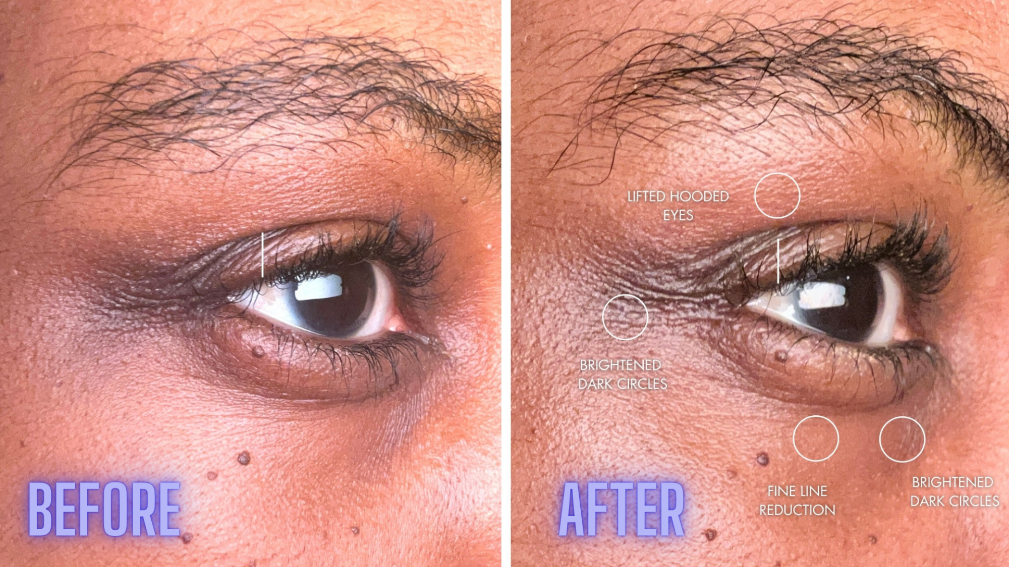 NIRA Pro Laser before and after